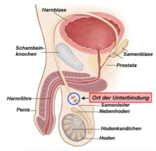 Vasektomie - Ort der Unterbindung